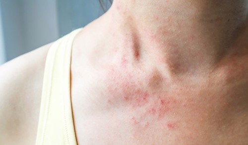 Triệu chứng và cách điều trị các loại bệnh eczema